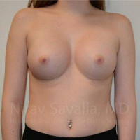 Breast Augmentation Before & After Gallery - Patient 1655555 - Image 2