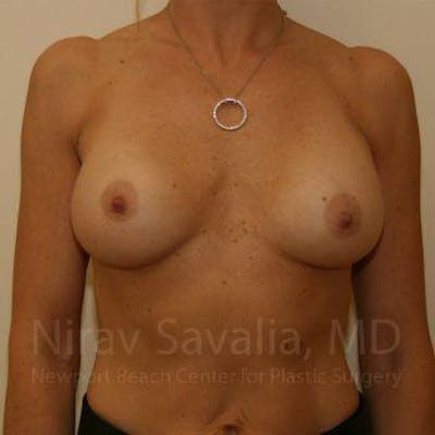 Breast Implant Revision Before & After Gallery - Patient 1655556 - Before