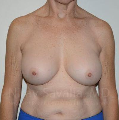 Breast Implant Revision Before & After Gallery - Patient 1655567
