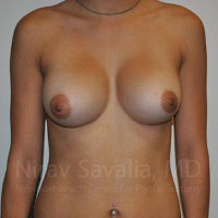 Breast Augmentation Before & After Gallery - Patient 1655573 - Image 2