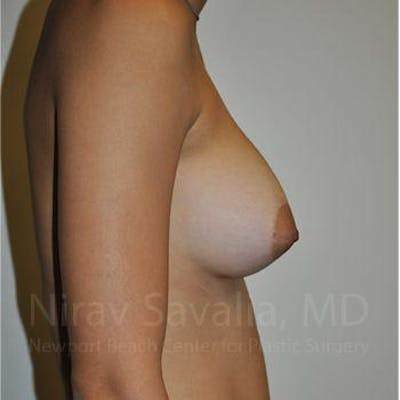 Breast Augmentation Before & After Gallery - Patient 1655573 - After