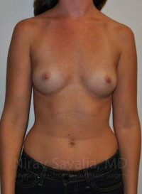 Breast Augmentation Before & After Gallery - Patient 1655574 - Image 1