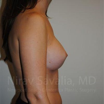 Breast Explantation En Bloc Capsulectomy Before & After Gallery - Patient 1655574 - After