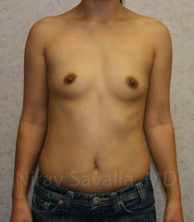 Breast Augmentation Before & After Gallery - Patient 1655576 - Before