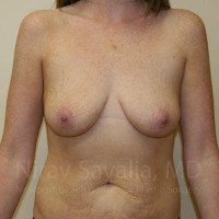 Breast Augmentation Before & After Gallery - Patient 1655579 - Image 1