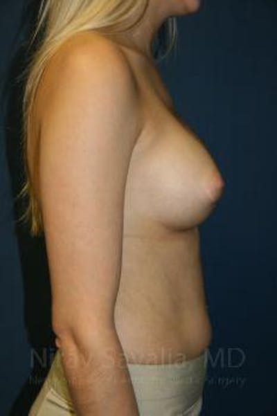 Mastectomy Reconstruction Revision Before & After Gallery - Patient 1655581 - After