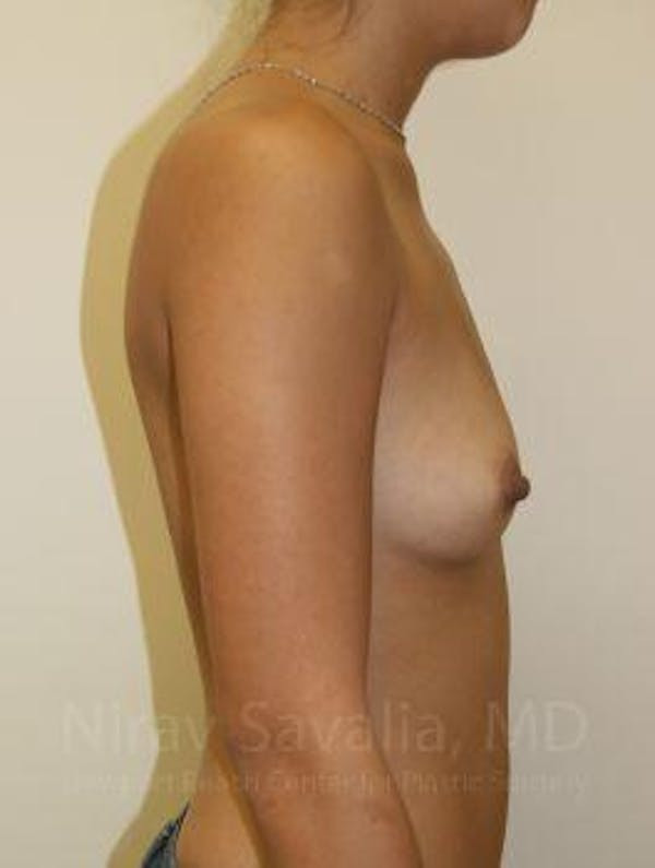 Breast Augmentation Before & After Gallery - Patient 1655586 - Before