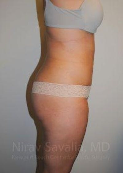 Breast Reduction Before & After Gallery - Patient 1655598 - After