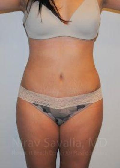 Breast Implant Revision Before & After Gallery - Patient 1655599