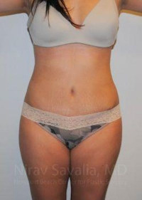 Liposuction Before & After Gallery - Patient 1655599 - Image 2