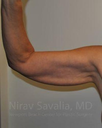 Arm Lift Before & After Gallery - Patient 1655600 - Before