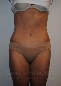 Abdominoplasty Tummy Tuck Before & After Gallery - Patient 1655601 - Image 2