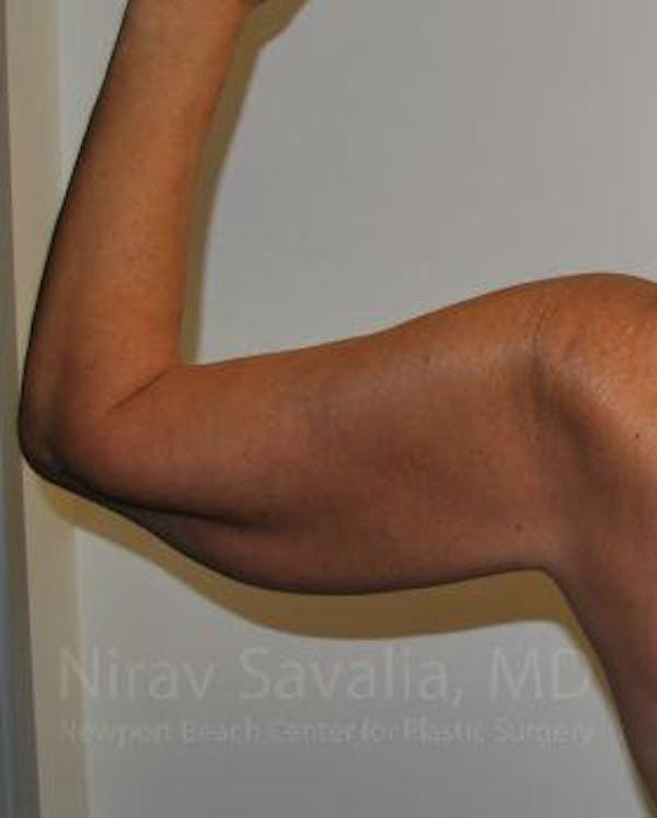 Arm Lift Before & After Gallery - Patient 1655600 - Before
