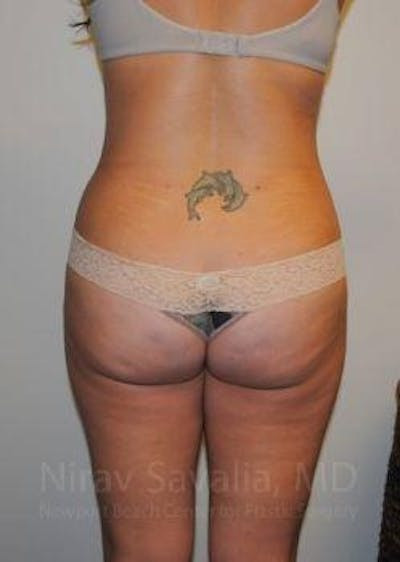 Liposuction Before & After Gallery - Patient 1655599 - After
