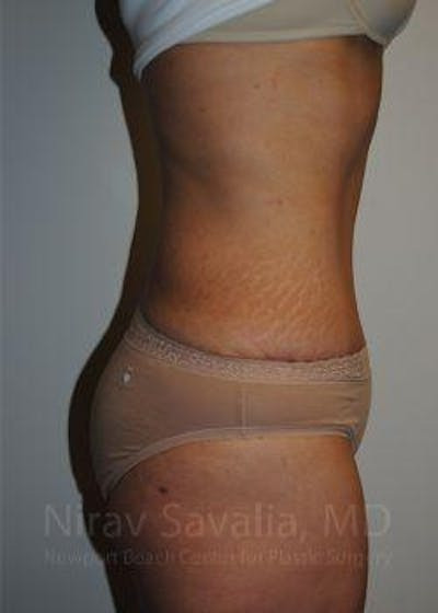 Breast Implant Revision Before & After Gallery - Patient 1655601 - After