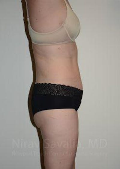 Thigh Lift Before & After Gallery - Patient 1655603 - After