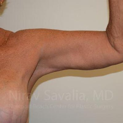 Male Breast Reduction Before & After Gallery - Patient 1655602 - After