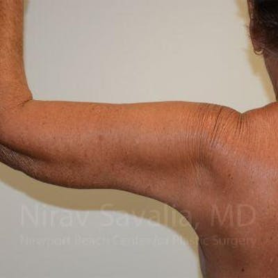 Mastectomy Reconstruction Revision Before & After Gallery - Patient 1655602 - After