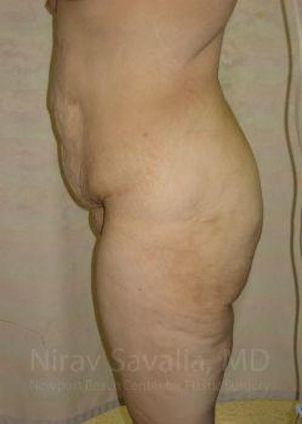 Thigh Lift Before & After Gallery - Patient 1655604 - Before