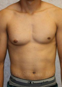 Male Breast Reduction Before & After Gallery - Patient 1655607 - Image 1