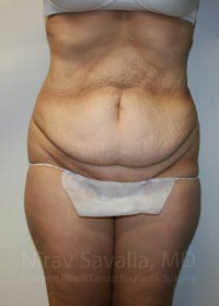 Liposuction Before & After Gallery - Patient 1655608 - Image 1