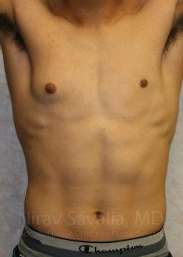 Male Breast Reduction Before & After Gallery - Patient 1655607 - Before