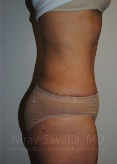 Oncoplastic Reconstruction Before & After Gallery - Patient 1655608 - After