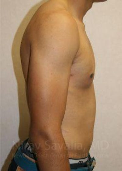 Breast Reduction Before & After Gallery - Patient 1655607 - After
