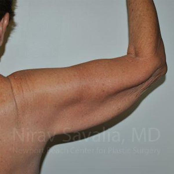 Arm Lift Before & After Gallery - Patient 1655610 - Before