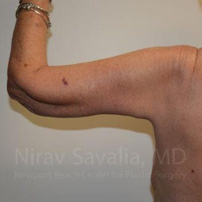 Liposuction Before & After Gallery - Patient 1655610 - After