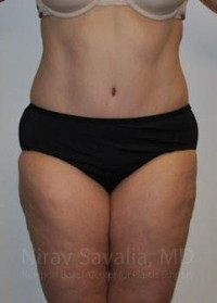 Abdominoplasty Tummy Tuck Before & After Gallery - Patient 1655617 - Image 2