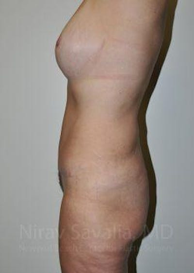 Arm Lift Before & After Gallery - Patient 1655623 - After