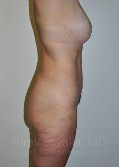 Mastectomy Reconstruction Revision Before & After Gallery - Patient 1655623 - After