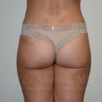 Liposuction Before & After Gallery - Patient 1655622 - Image 2