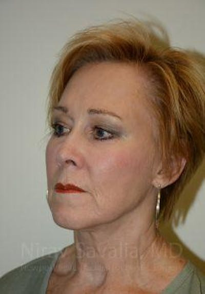 Facelift Before & After Gallery - Patient 1655625 - After