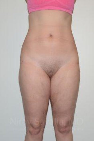 Body Contouring after Weight Loss Before & After Gallery - Patient 1655629 - After