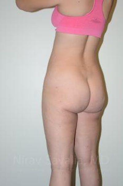 Liposuction Before & After Gallery - Patient 1655629 - After