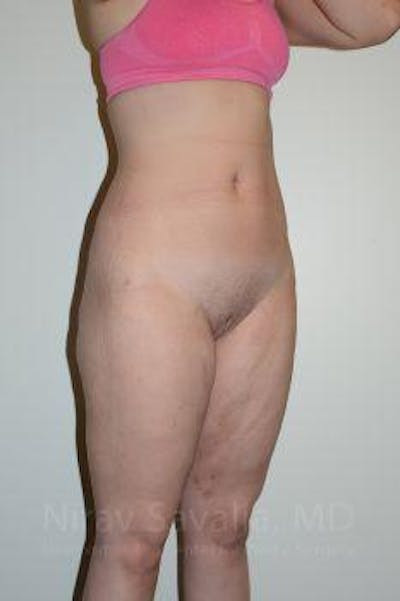 Mastectomy Reconstruction Revision Before & After Gallery - Patient 1655629 - After