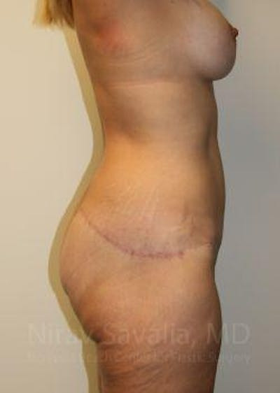 Liposuction Before & After Gallery - Patient 1655631 - After