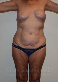 Abdominoplasty Tummy Tuck Before & After Gallery - Patient 1655634 - Image 1