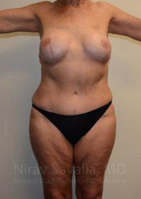 Abdominoplasty Tummy Tuck Before & After Gallery - Patient 1655634 - Image 2
