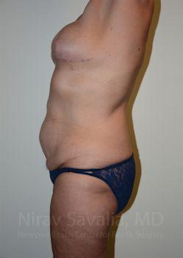 Abdominoplasty Tummy Tuck Before & After Gallery - Patient 1655634 - Before