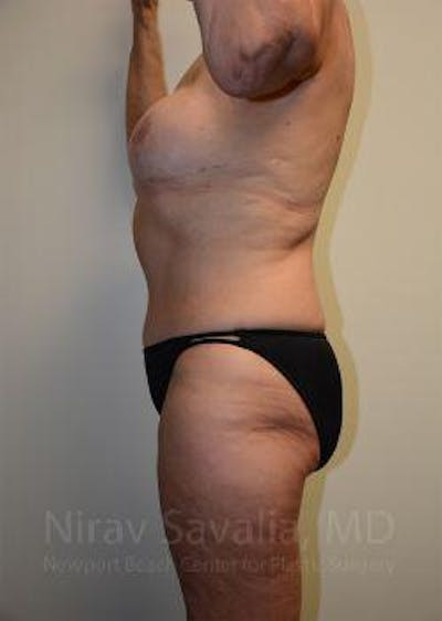 Liposuction Before & After Gallery - Patient 1655634 - After