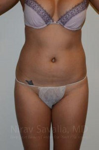 Liposuction Before & After Gallery - Patient 1655637 - Image 1