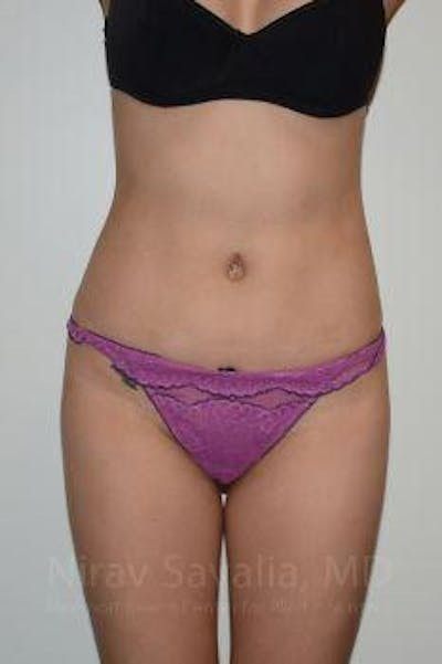 Liposuction Before & After Gallery - Patient 1655637 - After