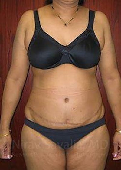 Body Contouring after Weight Loss Before & After Gallery - Patient 1655636