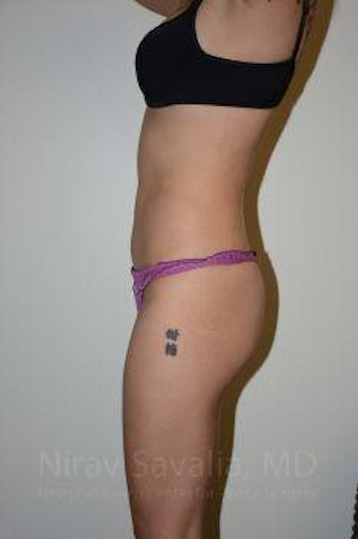 Liposuction Before & After Gallery - Patient 1655637 - After