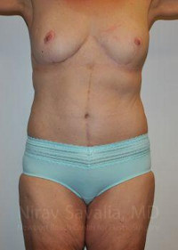 Body Contouring after Weight Loss Before & After Gallery - Patient 1655640 - Image 2