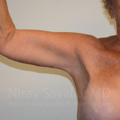 Breast Explantation En Bloc Capsulectomy Before & After Gallery - Patient 1655646 - After