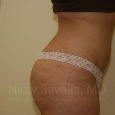 Thigh Lift Before & After Gallery - Patient 1655647 - After